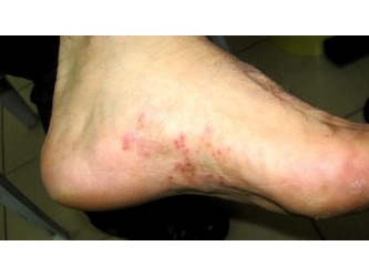 Athletes Foot Cures - Pictures